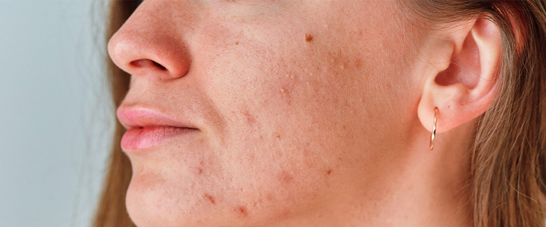 Smanjenje maljavosti i akni uz Cytofem Control